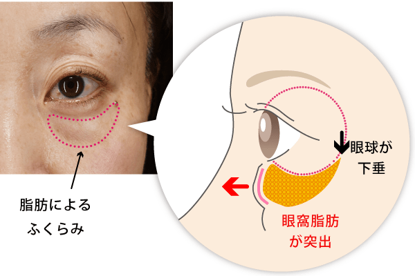 目の下のクマ、たるみの原因とは