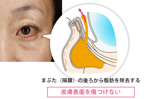 切らない目の下の脱脂（経結膜的下眼瞼脱脂術）