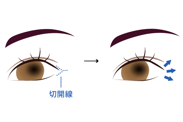 目尻切開の手術方法