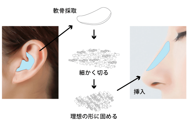 安全、持続性の高い最先端の「細片軟骨グルーグラフト移植」