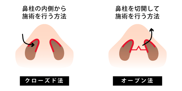 傷跡が見えないクローズド法