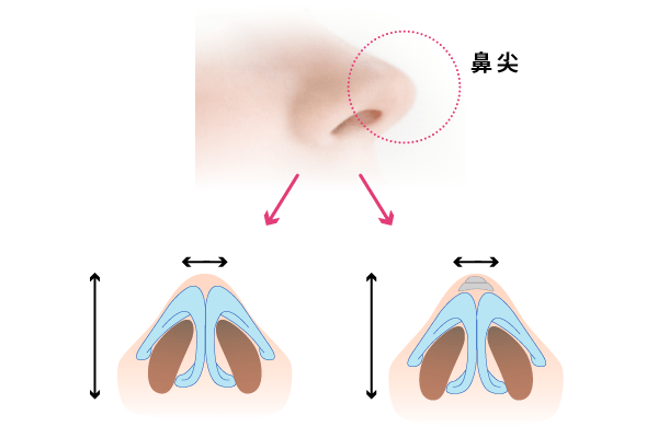 だんご鼻を解消して、スッと高い鼻先に