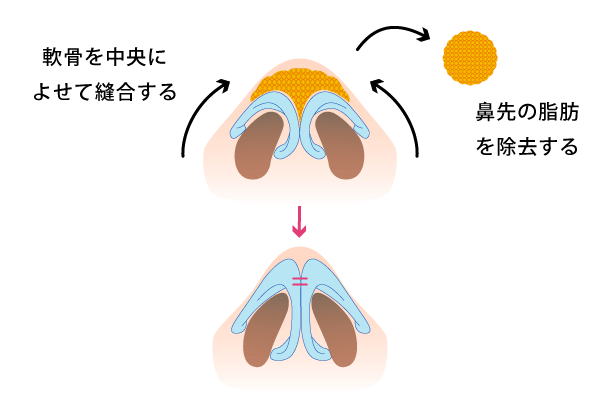 だんご鼻の原因を取り除き、スッと高い鼻に