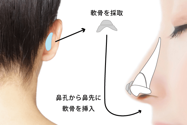 耳介軟骨の移植して、より高く整った鼻先に