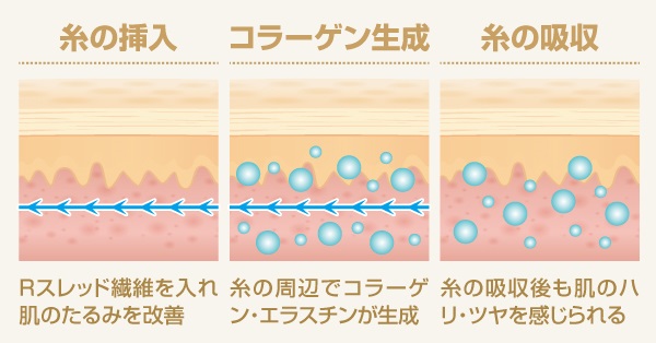 スレッドリフト挿入後の効果